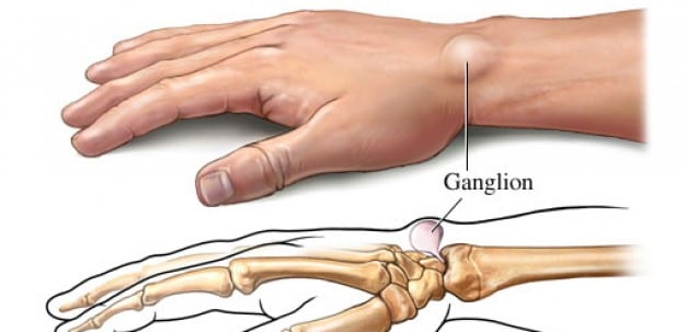 Do You Suffer From Ganglion Cysts?